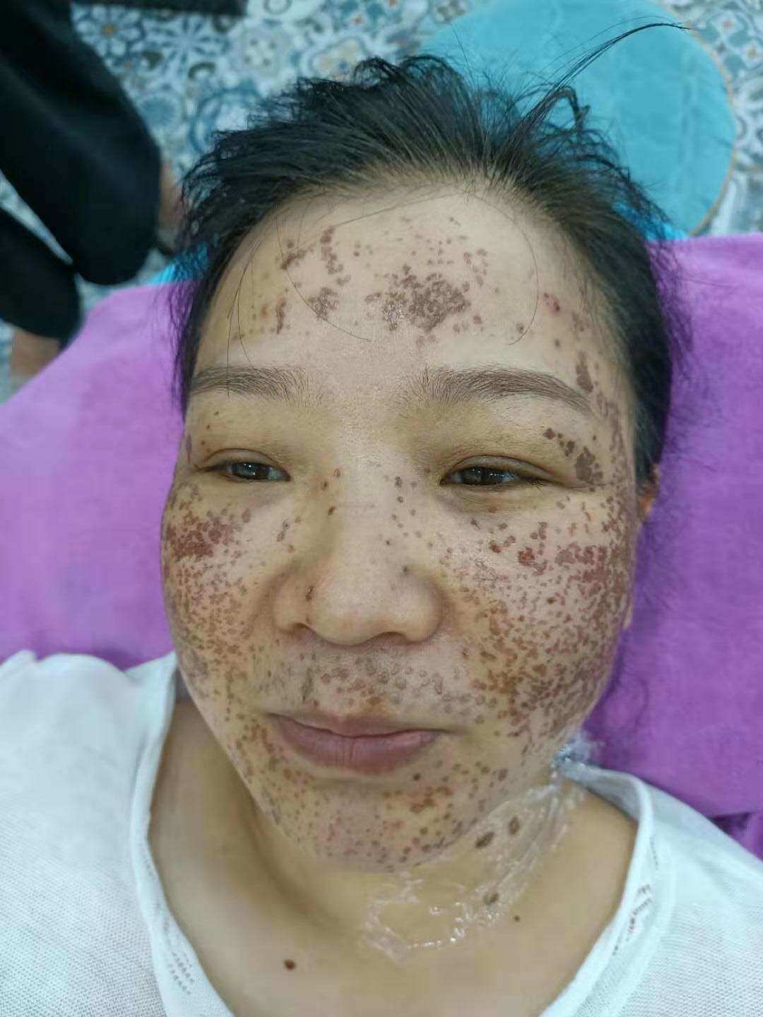 男性祛斑什么比较好_男性祛斑用什么效果最好_男性祛青春痘祛斑