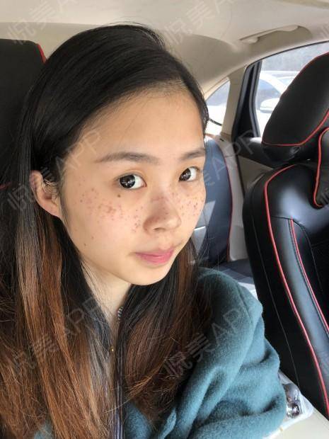 什么会损害内皮功能_酵素会损害皮肤正常功能吗_激光会对肌肤有损害吗