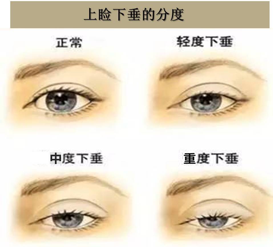 小孩的眼睛睑结膜上有个小疙瘩_做上睑下垂矫正术_老年眼睑下垂矫正手术