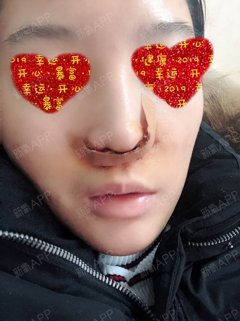 鼻头鼻翼缩小手术多少钱_鼻翼缩小手术对比图_谁做过鼻翼缩小手术