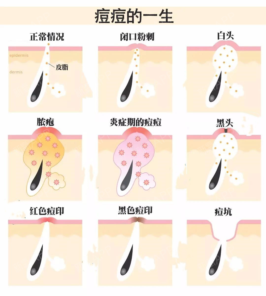 怎么祛痘印 痘印就该这么祛_如何祛痘疤/痘印_怎么祛痘印痘印