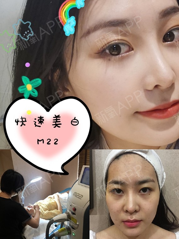 全身有用吗 激光全身美白的原理_全身激光美白要多少钱_激光美白全身多少钱