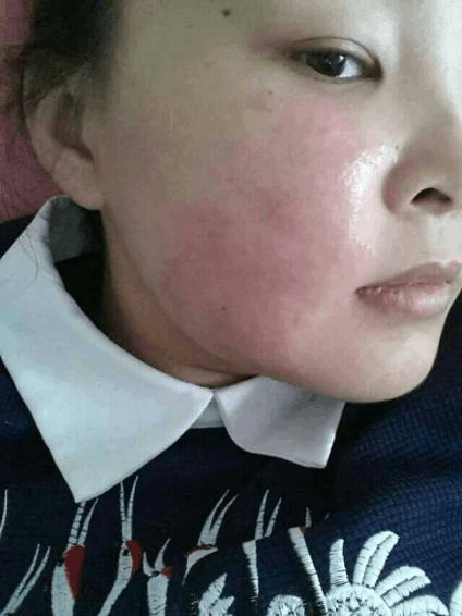 黄褐斑有效去除方法_简单有效去红血丝的方法_6招有效护肤方法有效去除红血丝
