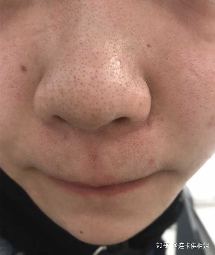 粉刺针怎么刮黑头白头_珍珠粉是如何完美清除黑头的_怎么用粉刺针刮黑头