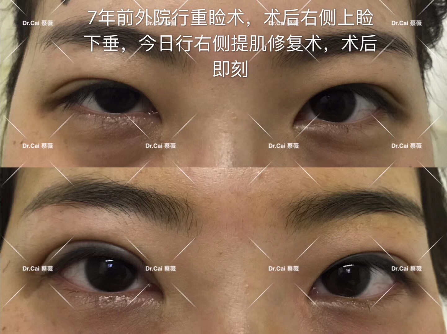 下垂乳房矫正_上睑下垂矫正手术_胸下垂矫正手术视频