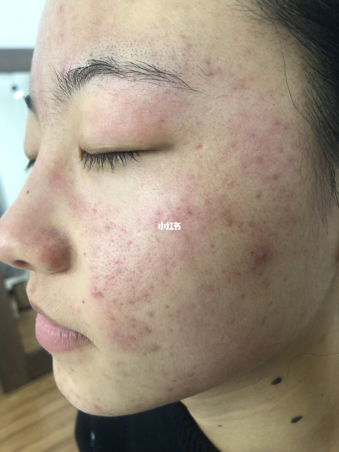 怎么调理痘痘脸_脸上长痘痘怎么调理_改善脸上痘痘