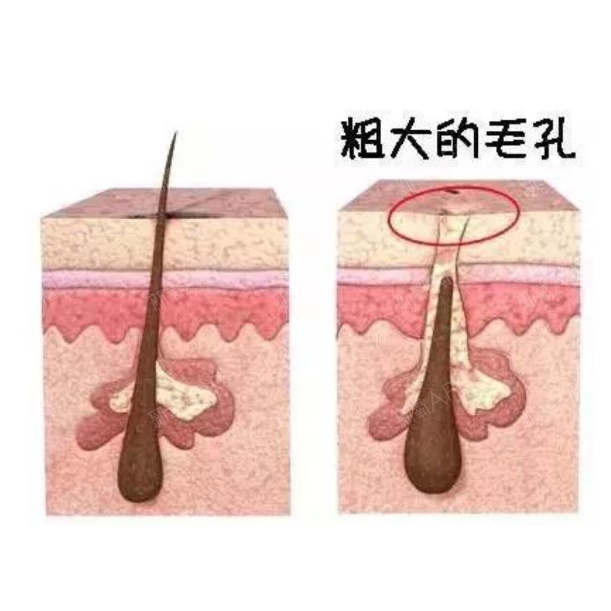 收缩毛孔的保湿水_保湿水能收缩毛孔吗_毛孔收缩保湿水能去黑头吗