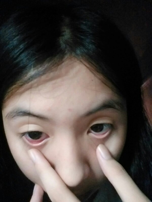 眼睛红血丝消除小偏方_眼睛红血丝消不掉怎么办_如何防止眼睛出现红血丝
