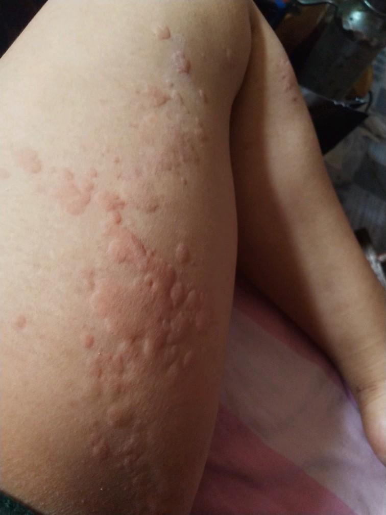 孕妇风疹病毒图片_孕妇风疹图片_孕妇的风疹怎么办