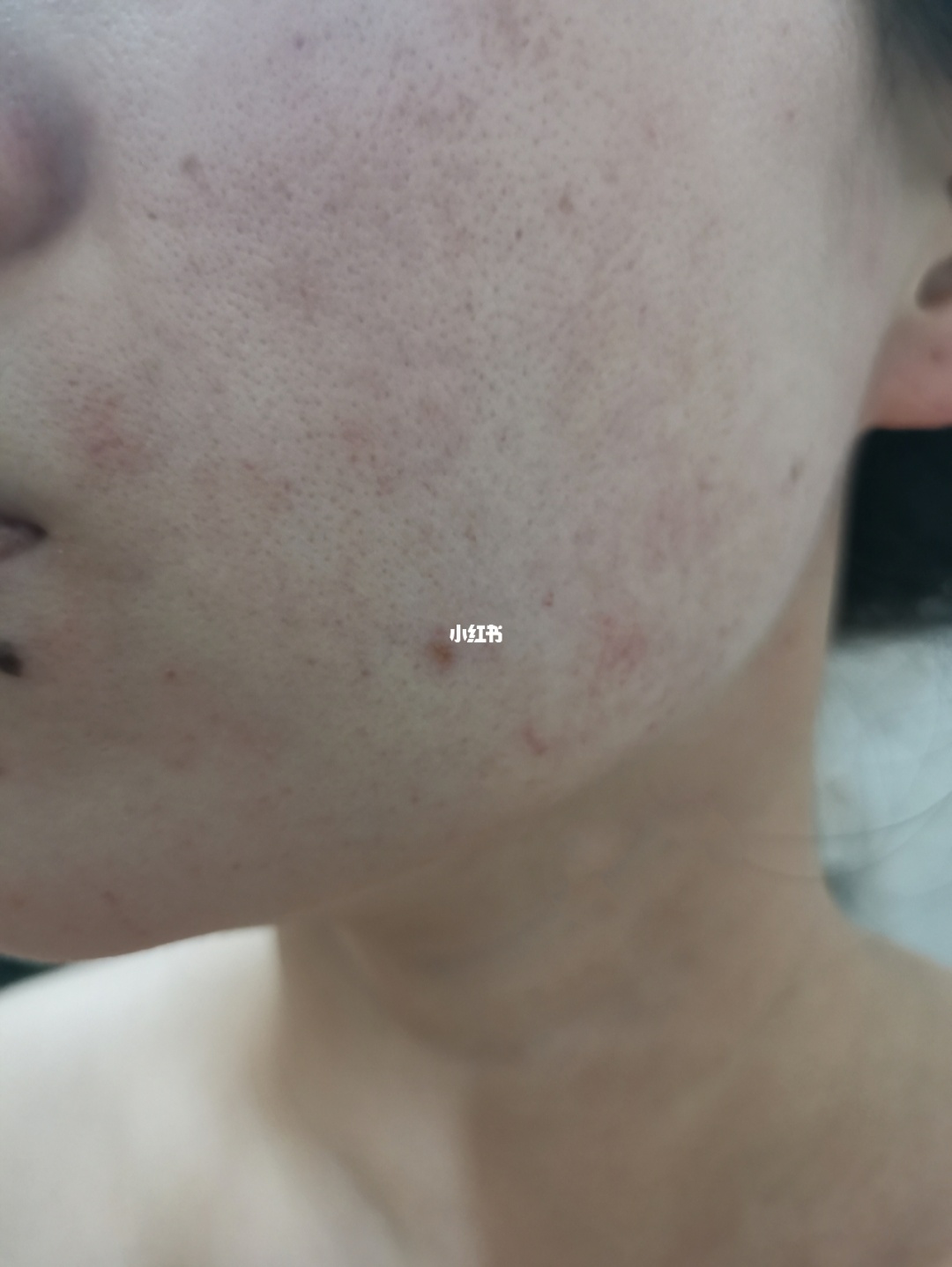 面部那些令人苦恼的红血丝是怎么来的_面部血丝明显是什么病_面部皮肤血丝