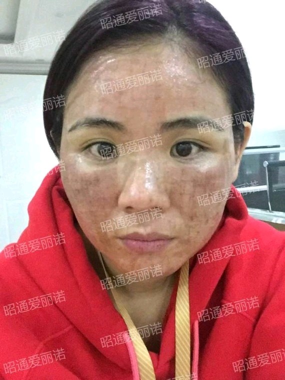 全身有用吗 激光全身美白的原理_全身激光美白效果_全身激光美白原理用有副作用吗