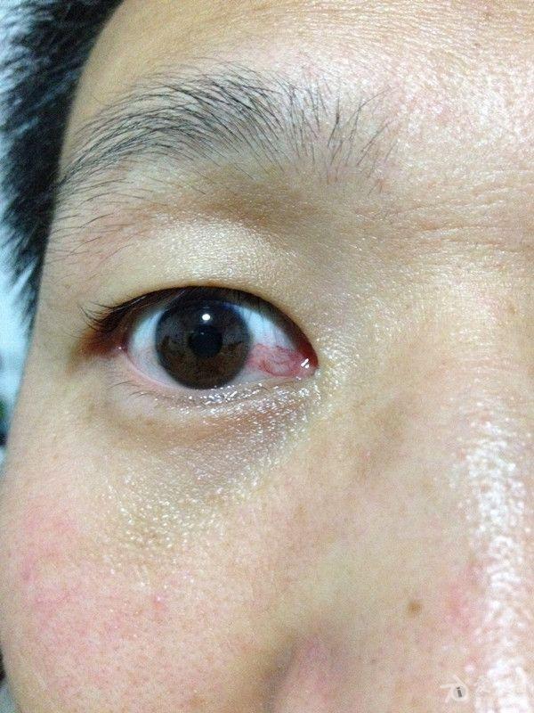 如何防止眼睛出现红血丝_眼睛红血丝如何_眼睛血丝缓解