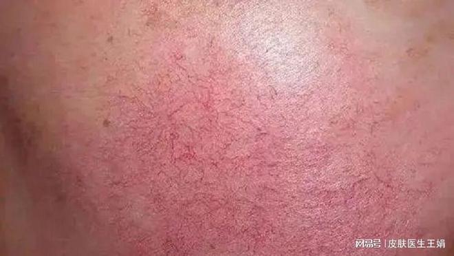 如何正确解决红血丝红血丝怎么消除_如何正确解决红血丝红血丝怎么消除_如何正确解决红血丝红血丝怎么消除