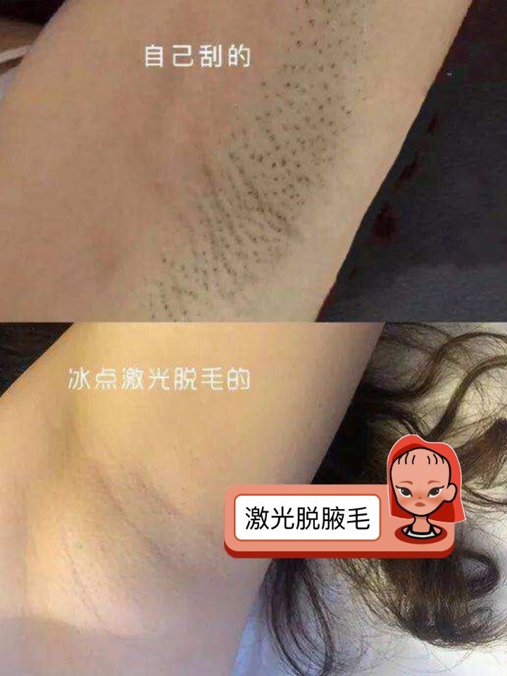激光会对肌肤有损害吗_激光损害肌肤会有什么症状_激光损害肌肤会有什么反应