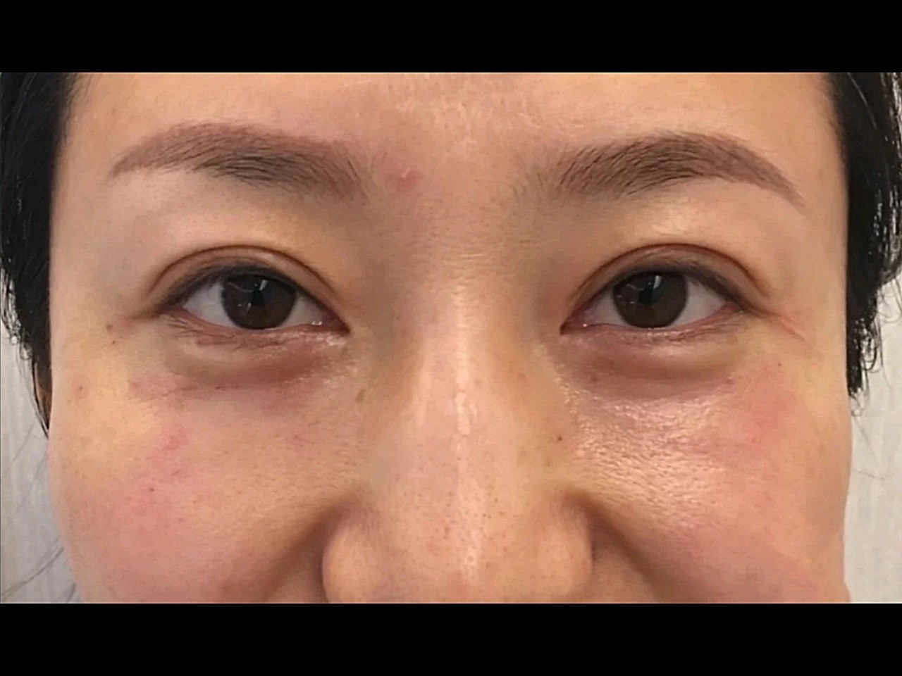 去除眼部细纹的方法有哪些_去除眼部细纹小窍门_如何去眼部细纹