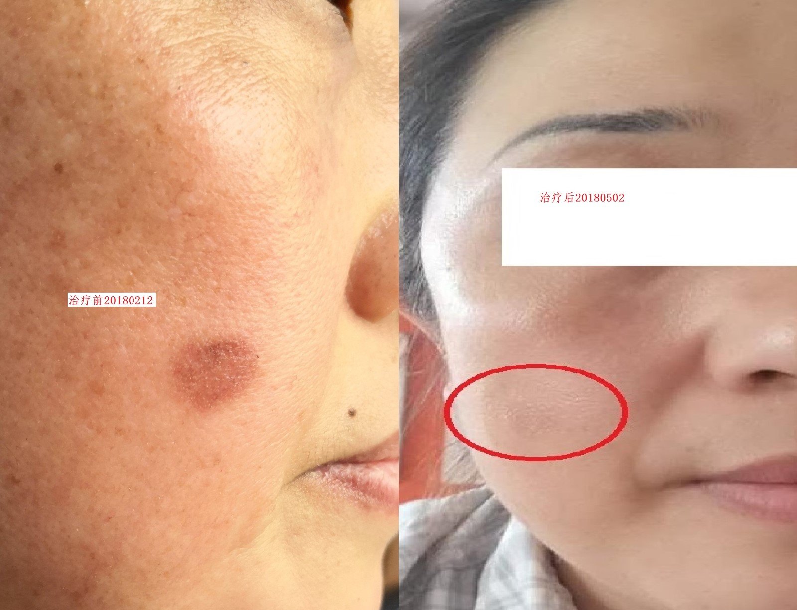 全身激光美白原理用有哪些_全身激光美白原理用有什么好处_全身有用吗 激光全身美白的原理