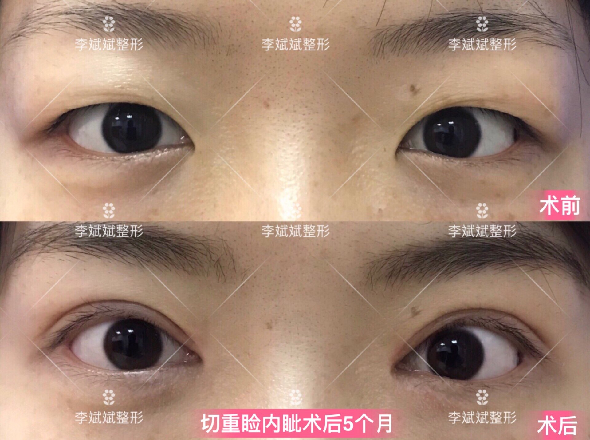 双眼皮全切图片_双眼皮切割图片_双眼皮切开图片