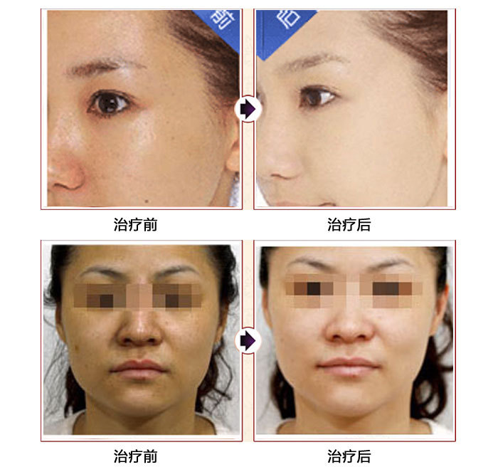 全身激光美白原理用有哪些_全身激光美白有什么副作用_全身有用吗 激光全身美白的原理