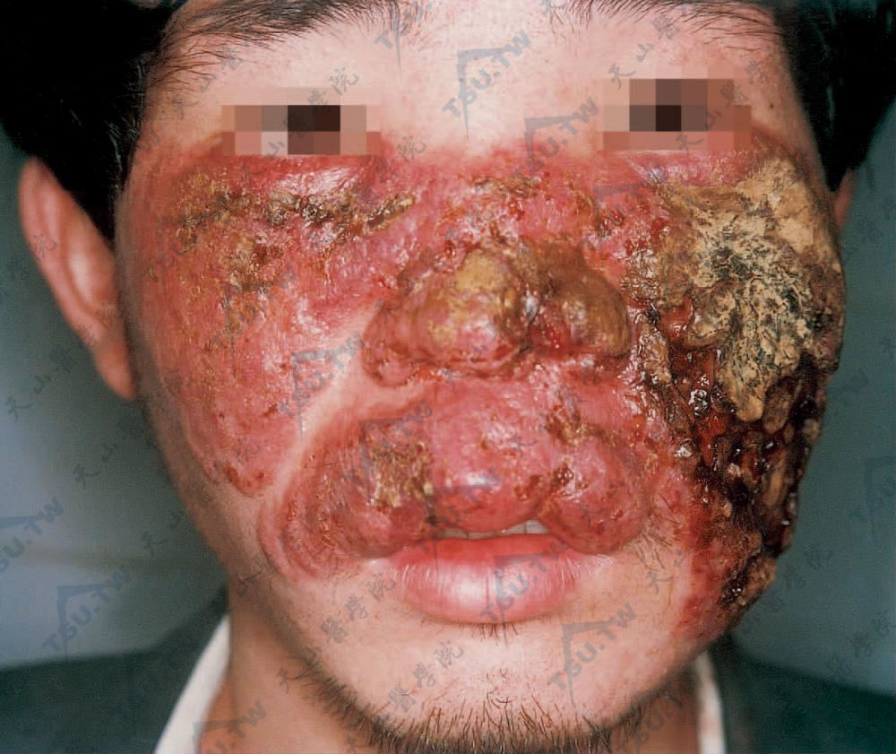 床螨虫咬了是什么症状_床螨虫图片大全_床上螨虫咬的症状图片