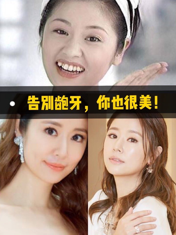 高圆圆整牙前后_高圆圆牙齿矫正前_高圆圆正畸前