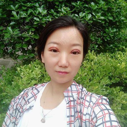 开内眼角手术_开眼角内切_眼角手术开内眼角好吗