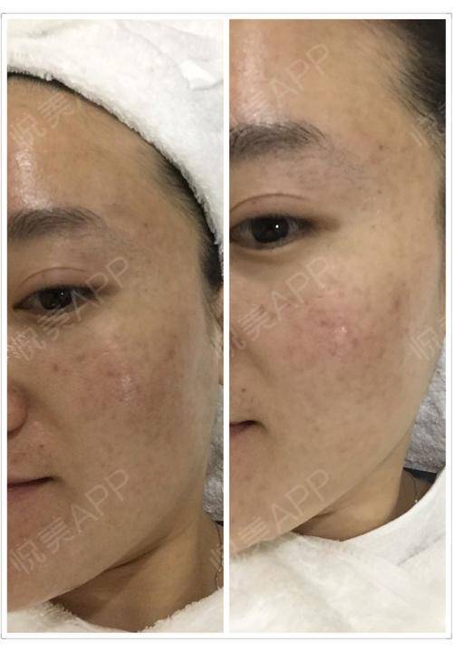 黑脸娃娃是什么意思_什么是黑脸娃娃_黑脸娃娃是解决哪类皮肤问题
