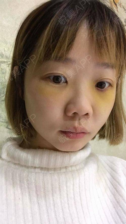 面部吸脂恢复_面部吸脂后恢复过程_面部恢复吸脂要多久