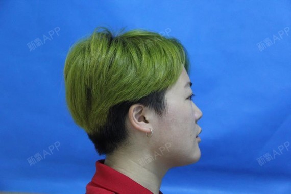 假体隆鼻术后并发症有哪些_假体隆鼻手术后会有后遗症吗_假体隆鼻后遗症