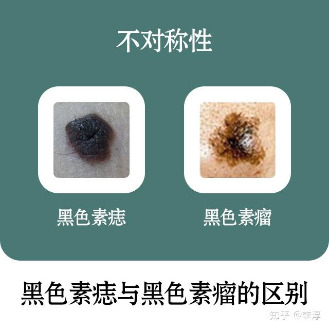 女子吸毒起幻觉变僵尸_女子除痣致癌变_女子一夜变八旬老太