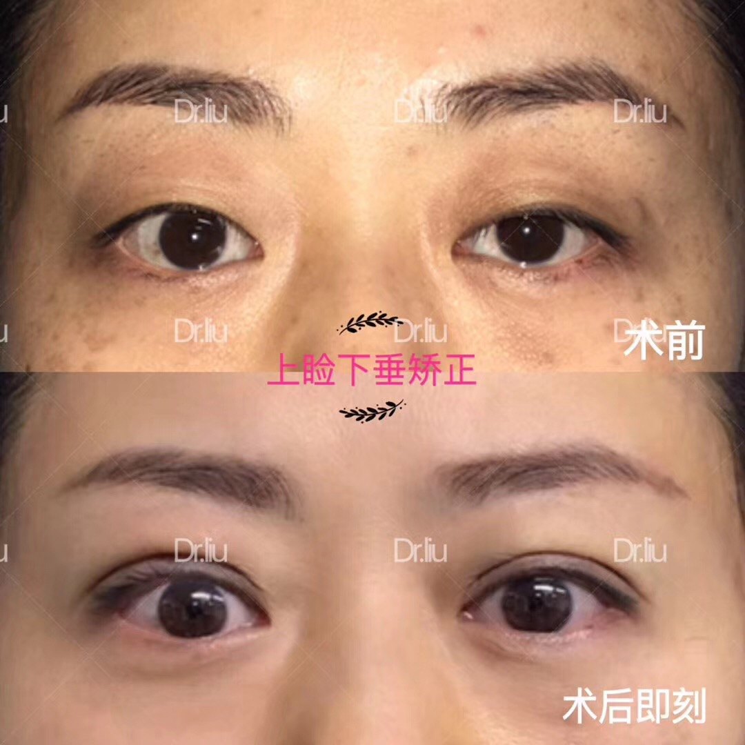 睑下垂矫正手术_上睑下垂矫正术需要住院吗_做上睑下垂矫正术