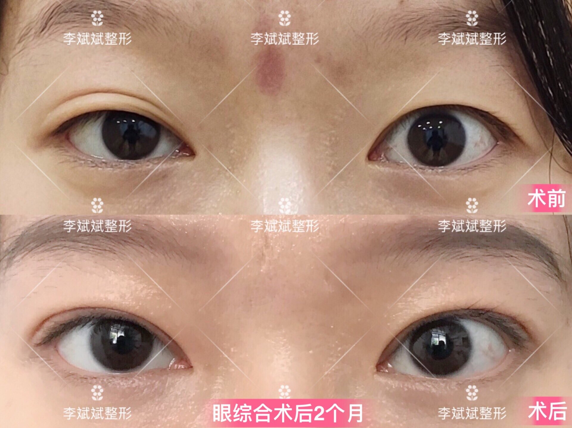 上睑下垂矫正术需要住院吗_做上睑下垂矫正术_睑下垂矫正手术